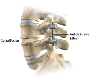 my-healthconnect_spinal_fusion
