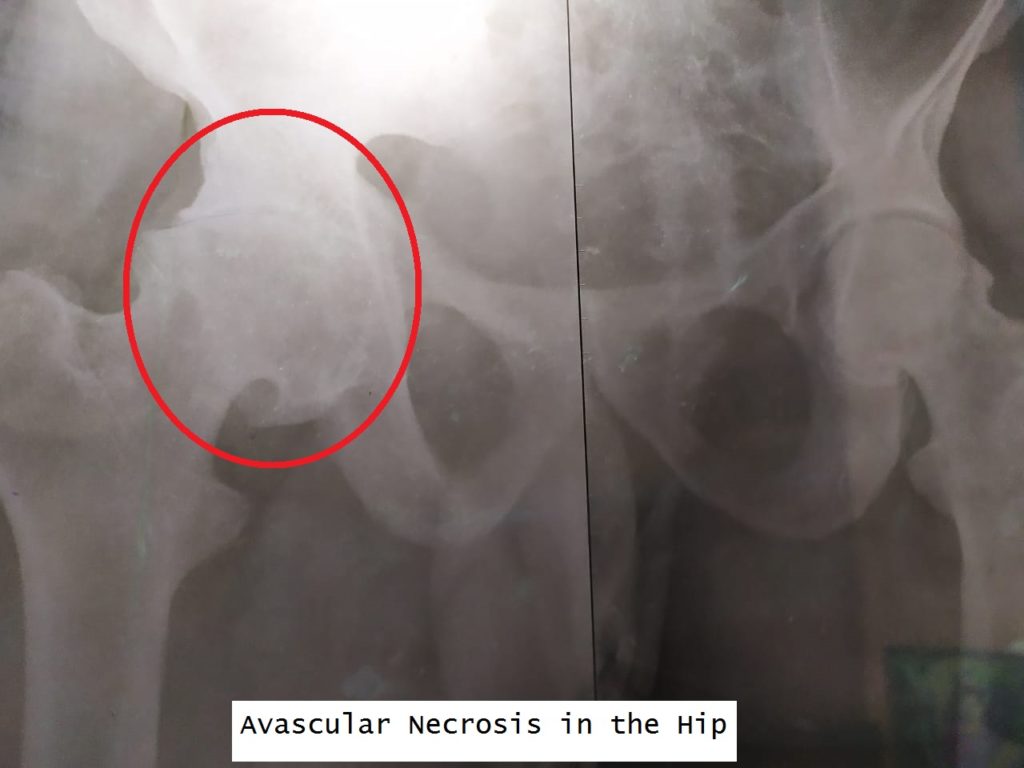 Avascular Necrosis, Hip Pain, Hip Replacement Surgery, Orthopedic Surgeons in India, Cost effective treatment plan